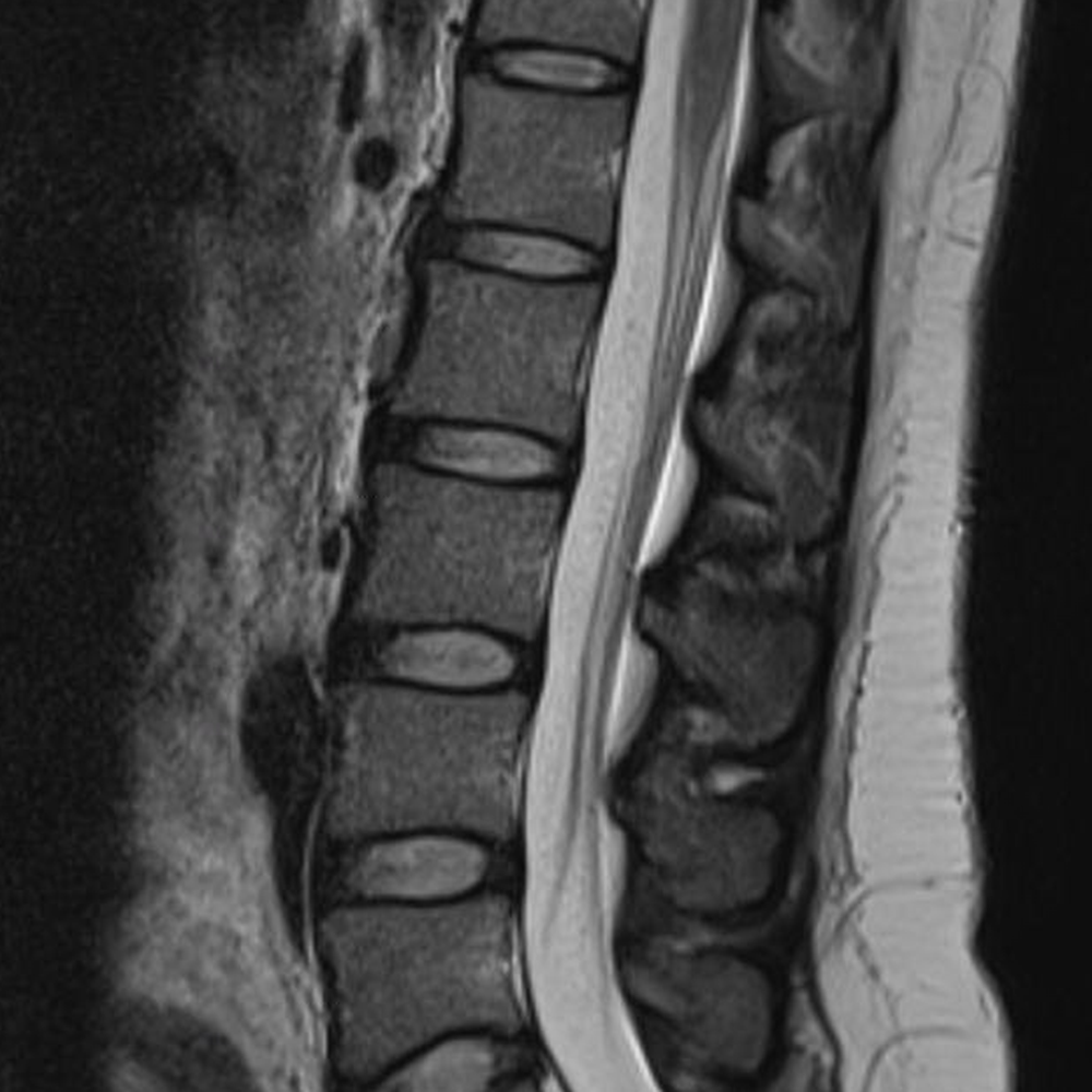 Note the epidural space on a sagittal T2, annotated on the next image.