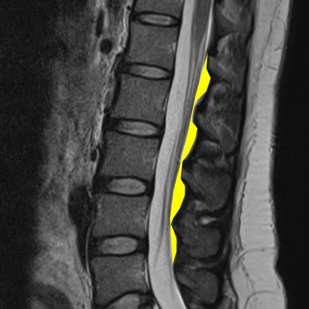 Yellow = dorsal epidural fat