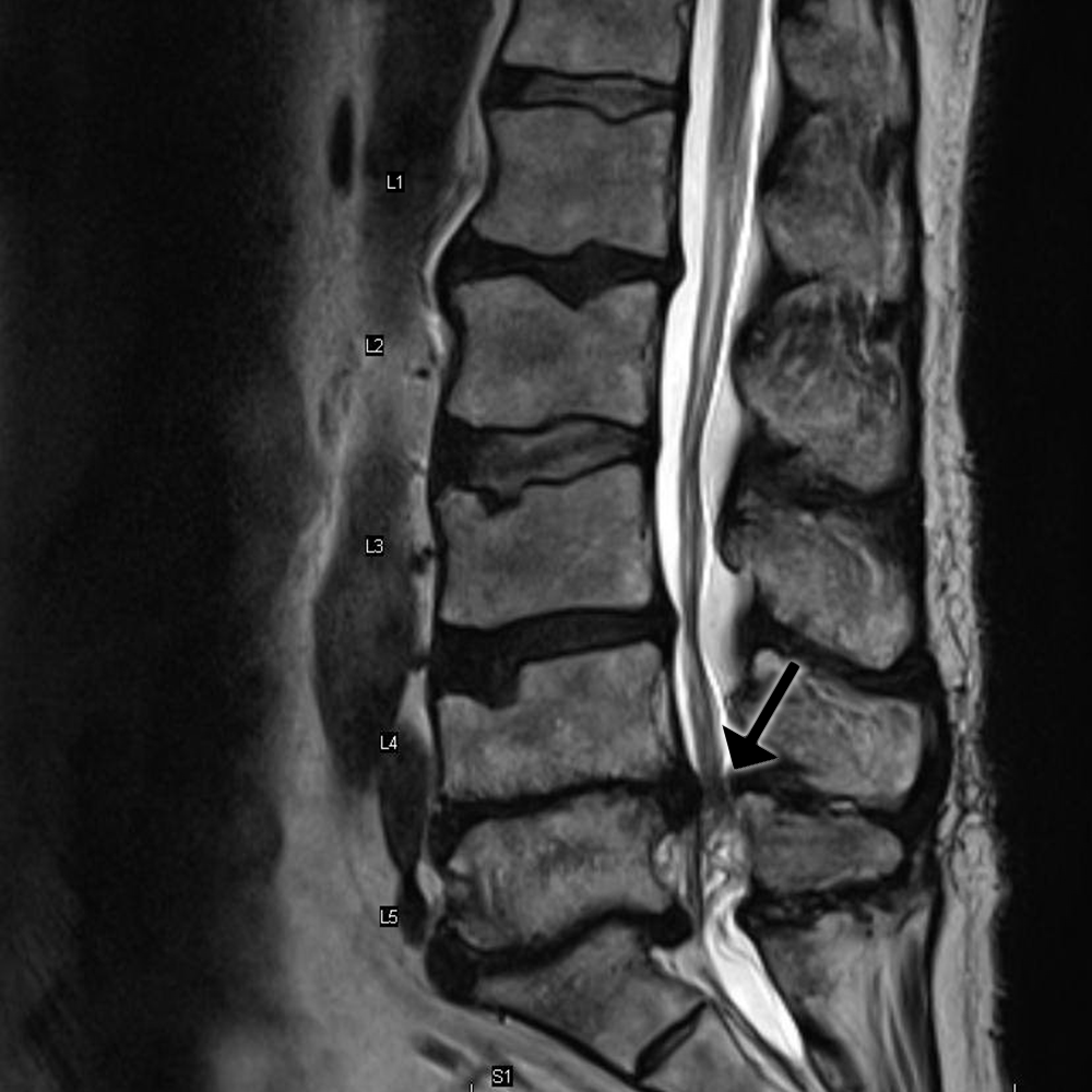 There is severe spinal canal narrowing at L4-L5 (arrow). It is easy to see that a lumbar puncture would not be successful at this level or below.